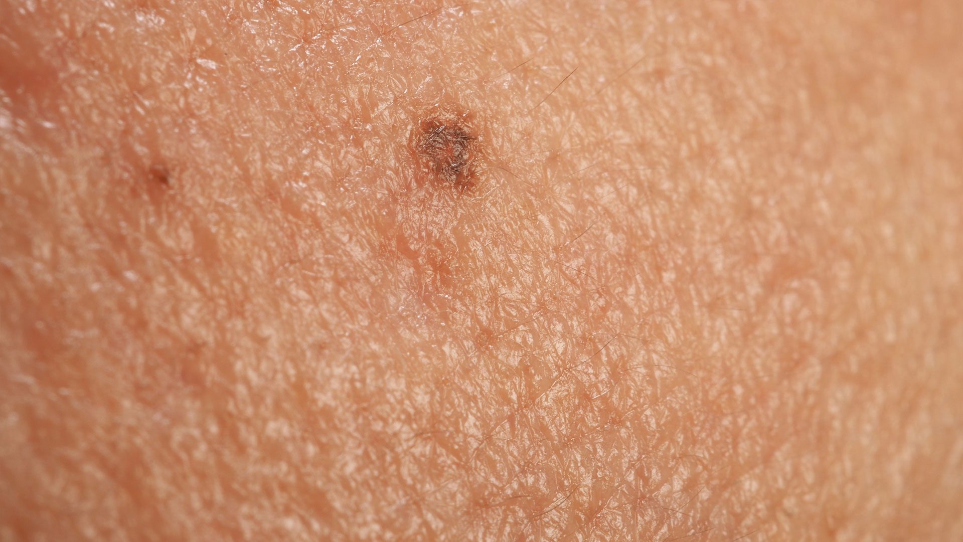 Actinic Keratoses and Dysplastic Nevi close up of human skin with a small dark mole