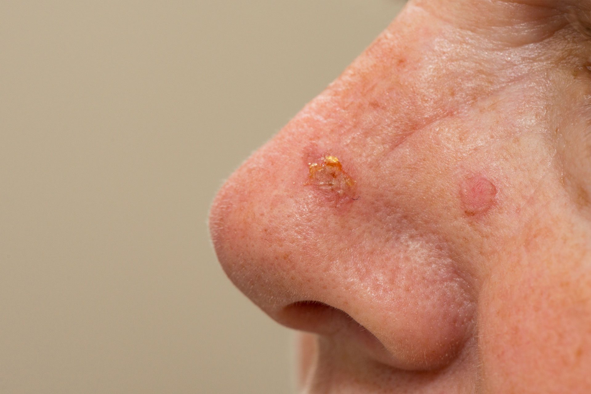 Actinic Keratoses and Dysplastic Nevi on Nose