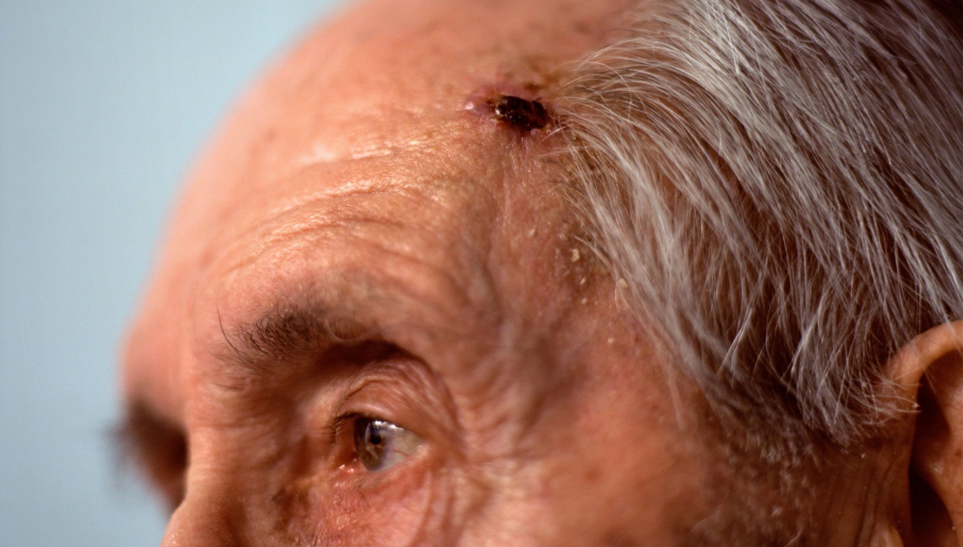 Basal Cell Carcinoma close up of elderly man