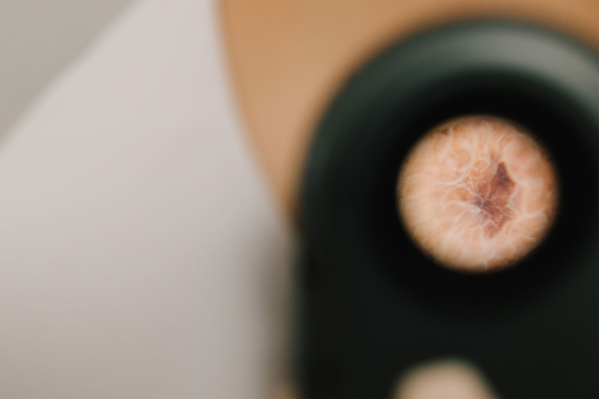 Melanoma close up of skin lesion