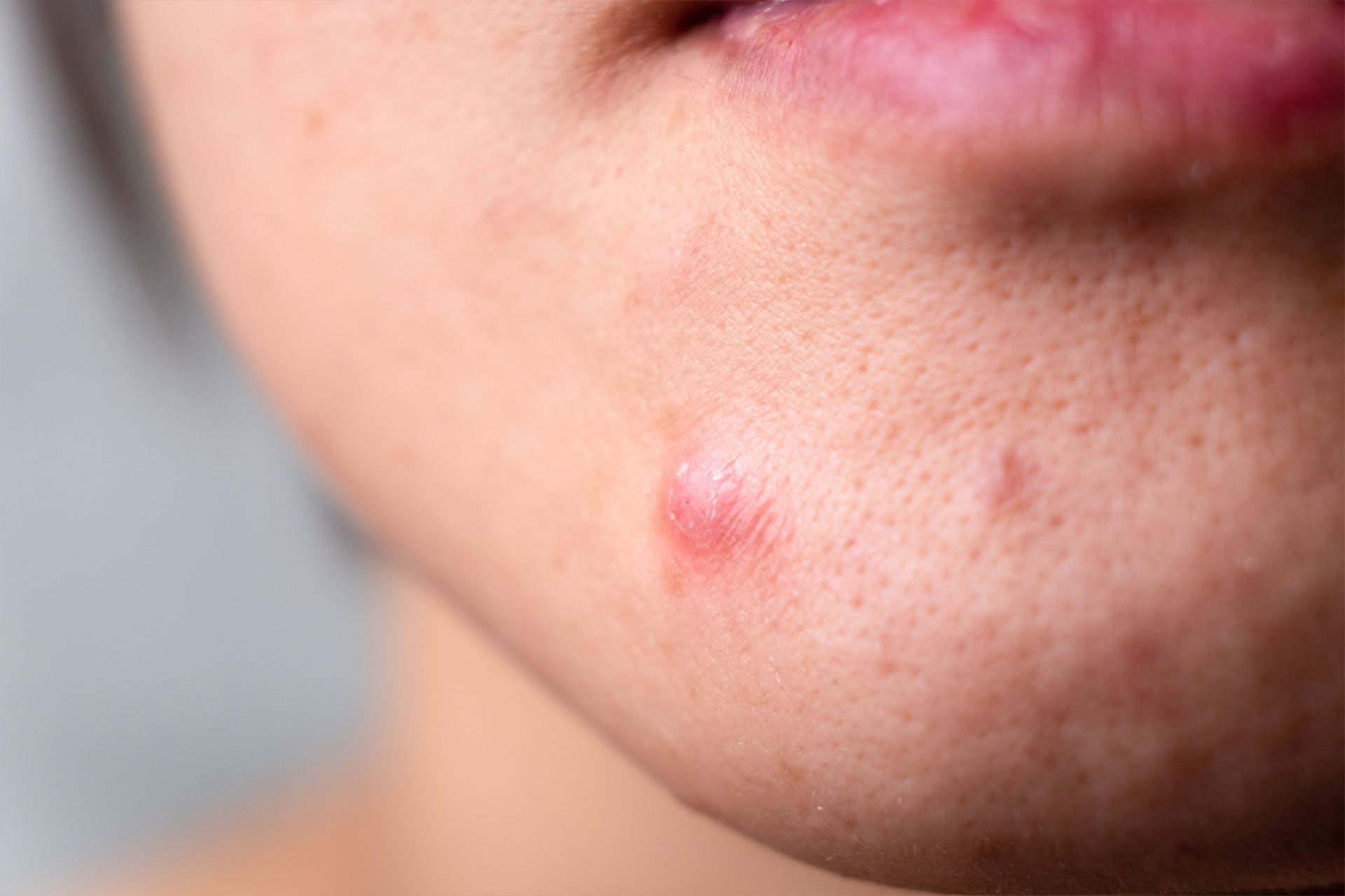 Pediatric Comprehensive Total Body Skin Examination Acne