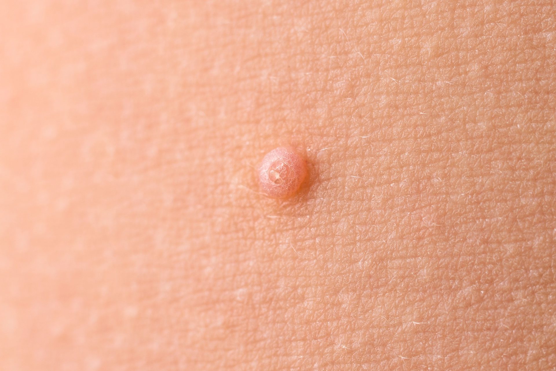 Pediatric Comprehensive Total Body Skin Examination skin tag