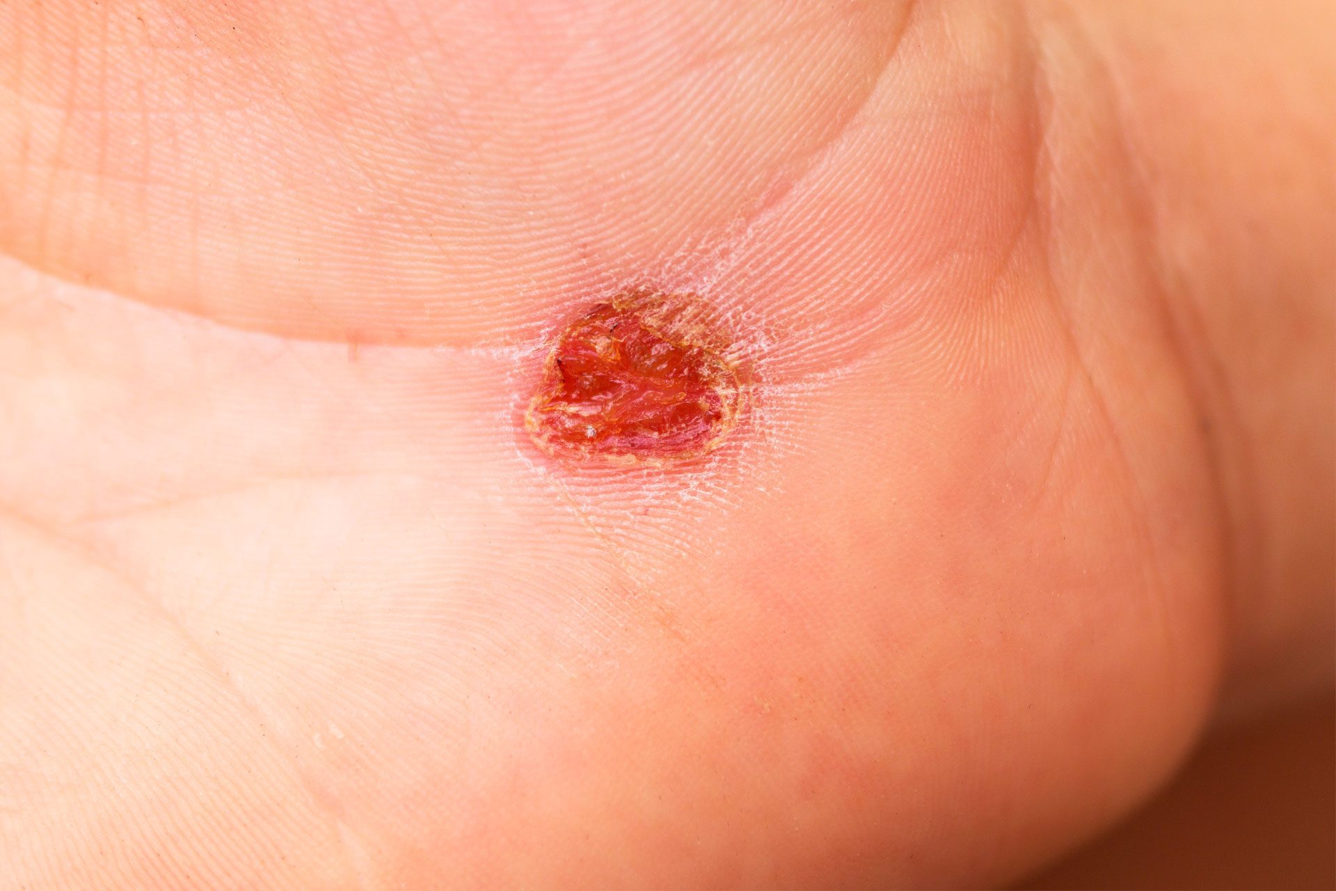 Squamous Cell Carcinoma close up of skin with a wound