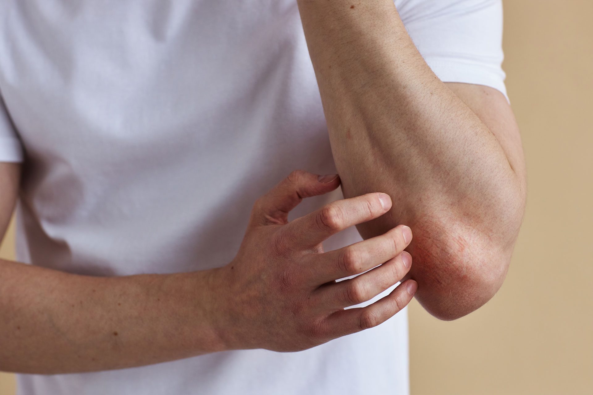 Total Body Skin Examination close up of elbow rash