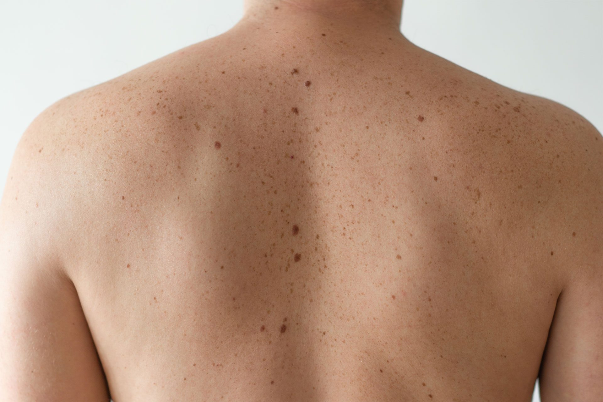 Total Body Skin Examination man back