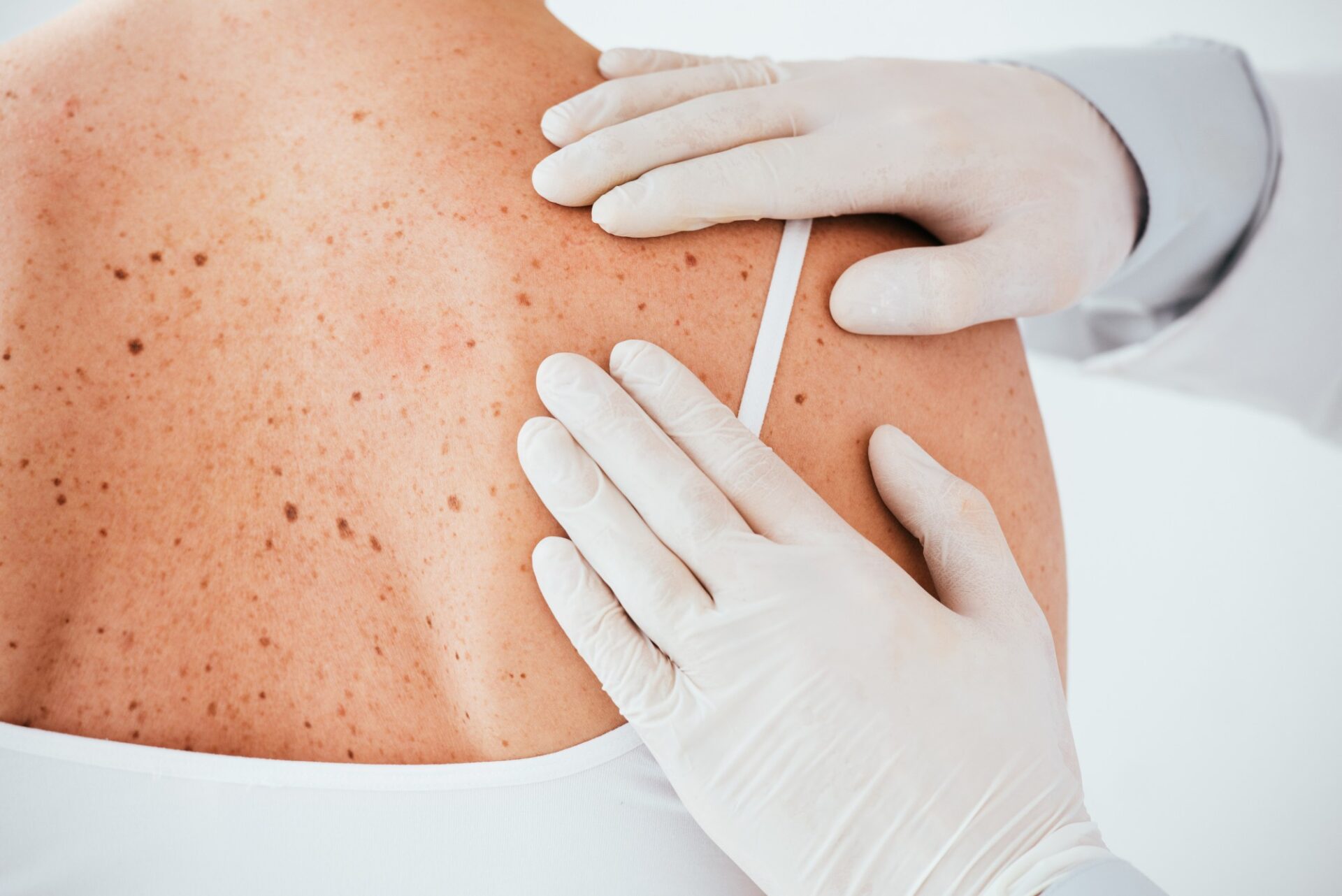 cropped view of dermatologist in latex gloves exam